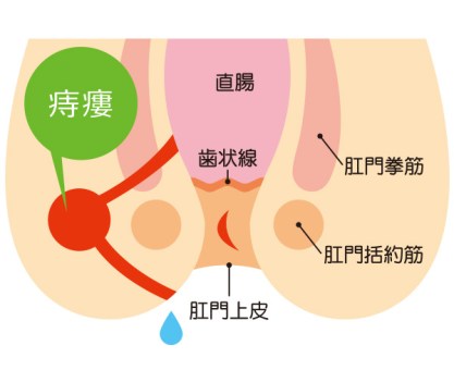 痔ろう（穴痔）