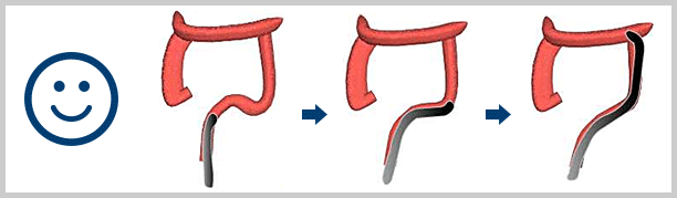 無痛大腸内視鏡挿入法（無送気軸保持短縮法）